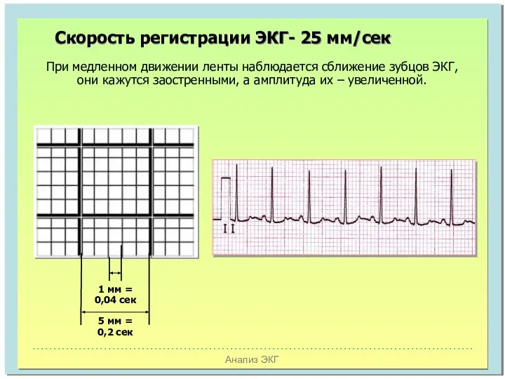 Анализ ЭКГ При медленном движении ленты наблюдается сближение зубцов ЭКГ, они