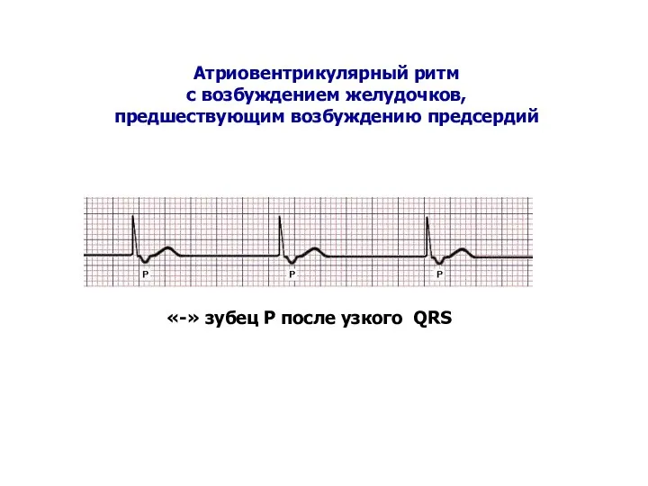 «-» зубец Р после узкого QRS Атриовентрикулярный ритм с возбуждением желудочков, предшествующим возбуждению предсердий