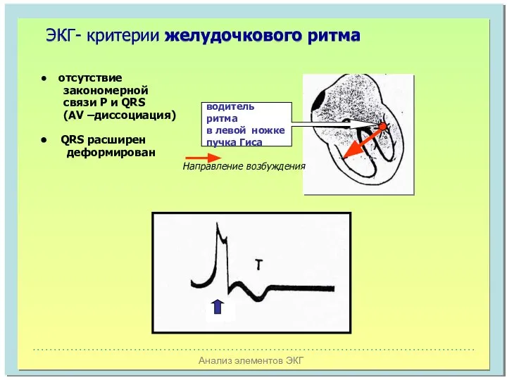 Анализ элементов ЭКГ ЭКГ- критерии желудочкового ритма водитель ритма в левой