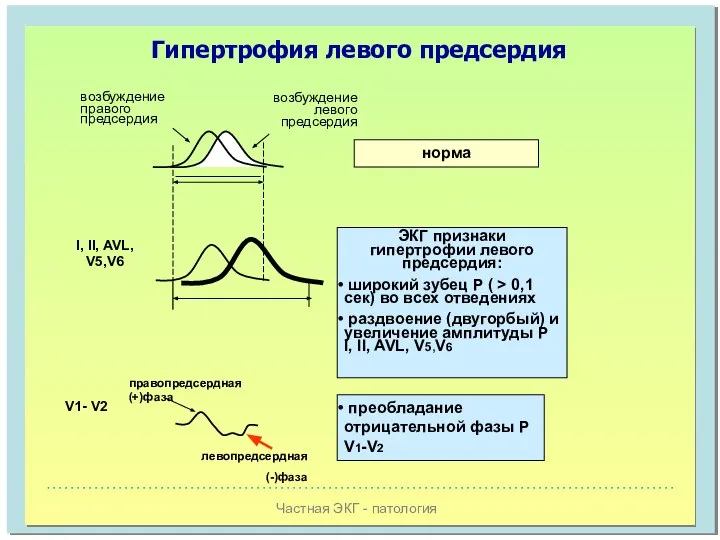 Частная ЭКГ - патология Гипертрофия левого предсердия возбуждение правого предсердия возбуждение