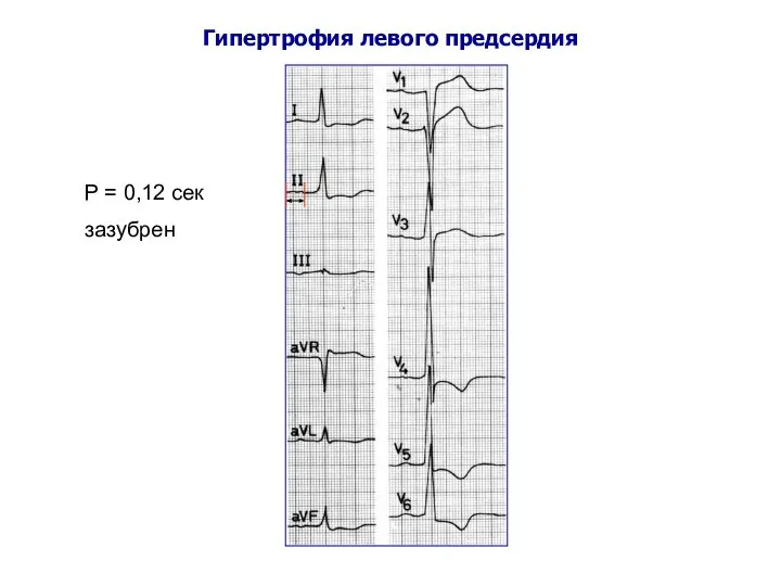 Гипертрофия левого предсердия Р = 0,12 сек зазубрен