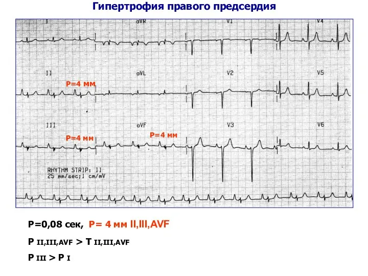 Гипертрофия правого предсердия Р=0,08 сек, Р= 4 мм II,III,AVF Р II,III,AVF