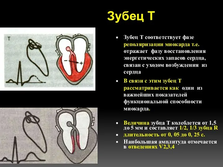 Зубец Т Зубец Т соответствует фазе реполяризации миокарда т.е. отражает фазу