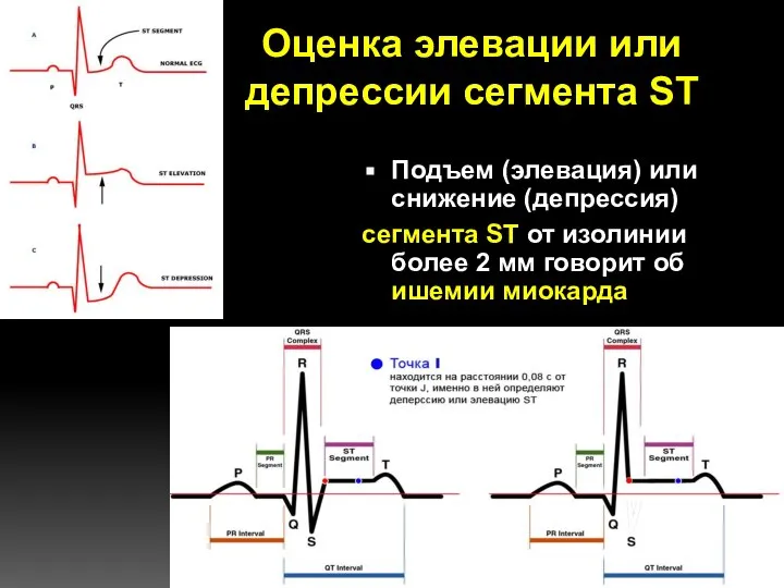 Оценка элевации или депрессии сегмента ST Подъем (элевация) или снижение (депрессия)