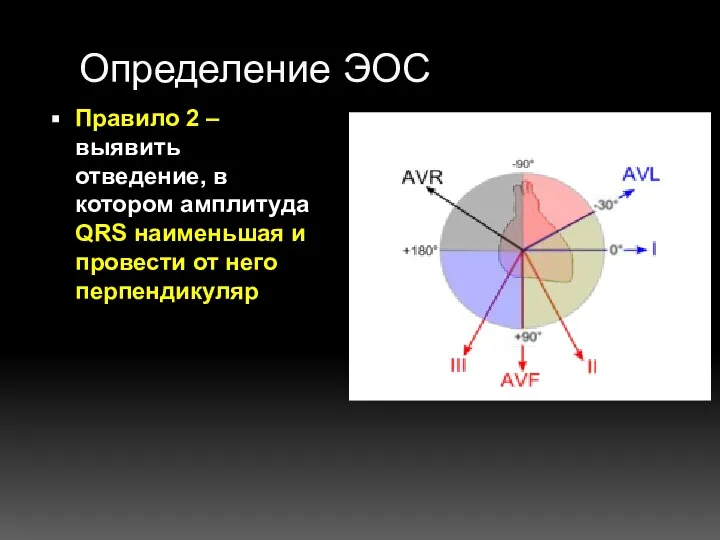 Определение ЭОС Правило 2 – выявить отведение, в котором амплитуда QRS