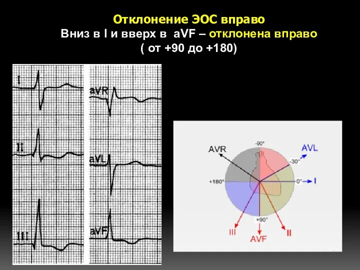 Отклонение ЭОС вправо Вниз в I и вверх в aVF –