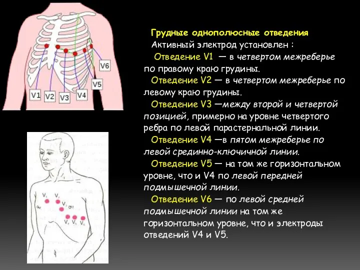 Грудные однополюсные отведения Активный электрод установлен : Отведение V1 — в