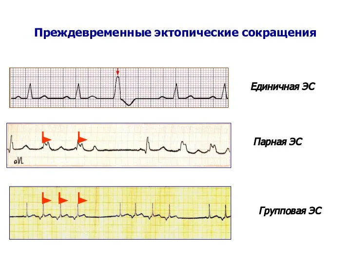 Преждевременные эктопические сокращения Единичная ЭС Парная ЭС Групповая ЭС