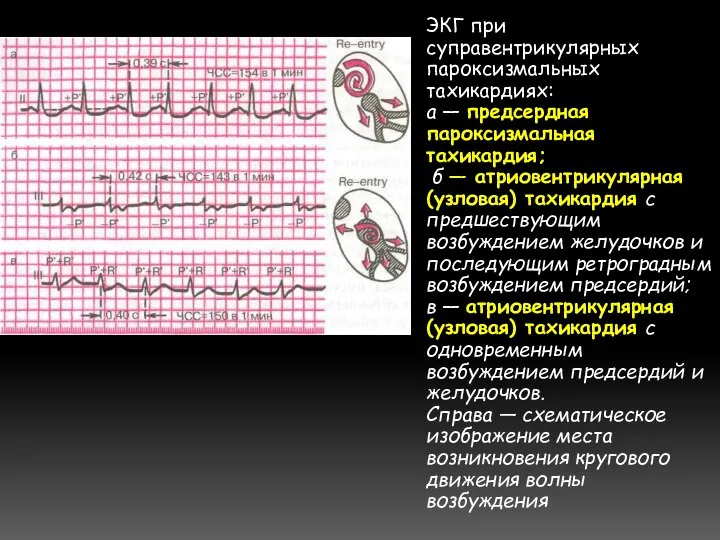 ЭКГ при суправентрикулярных пароксизмальных тахикардиях: а — предсердная пароксизмальная тахикардия; б