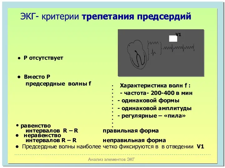 Анализ элементов ЭКГ ЭКГ- критерии трепетания предсердий V1 Характеристика волн f