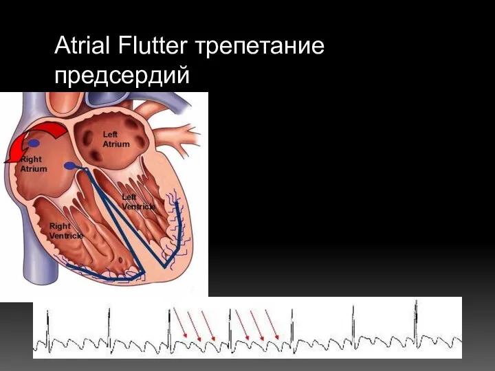 Atrial Flutter трепетание предсердий