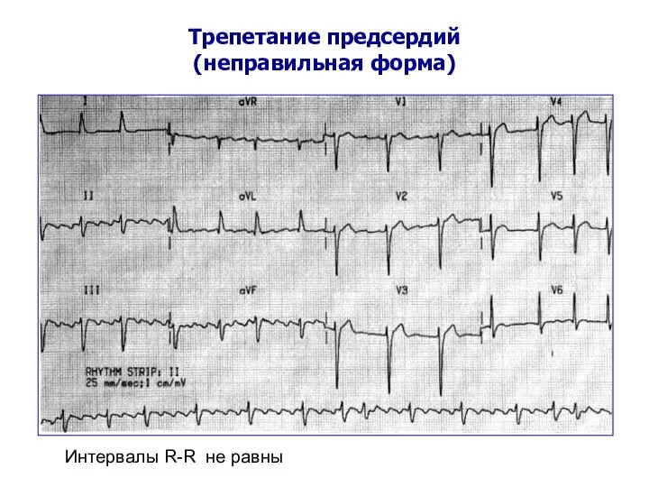 Трепетание предсердий (неправильная форма) Интервалы R-R не равны