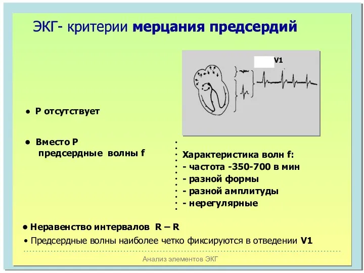 Анализ элементов ЭКГ ЭКГ- критерии мерцания предсердий Р отсутствует Вместо Р