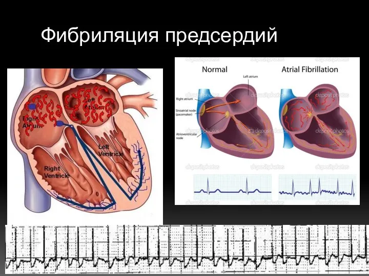 Фибриляция предсердий