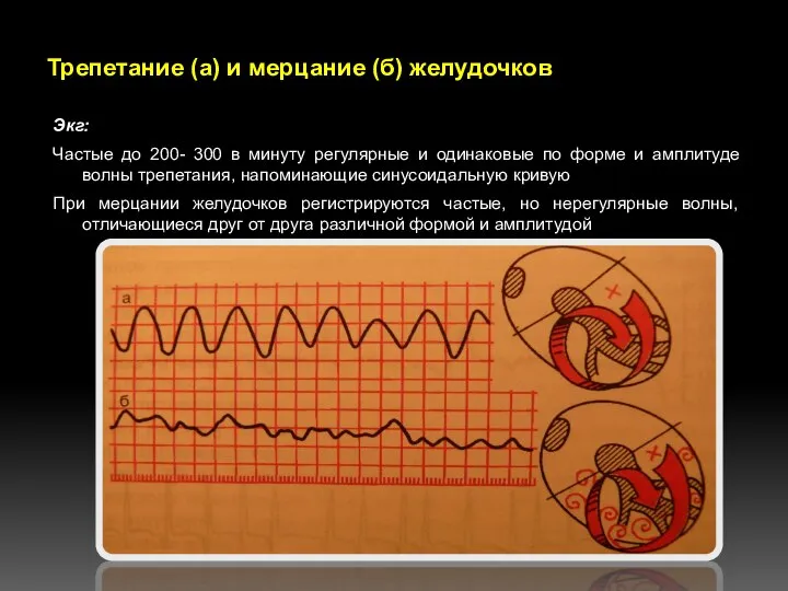 Трепетание (а) и мерцание (б) желудочков Экг: Частые до 200- 300