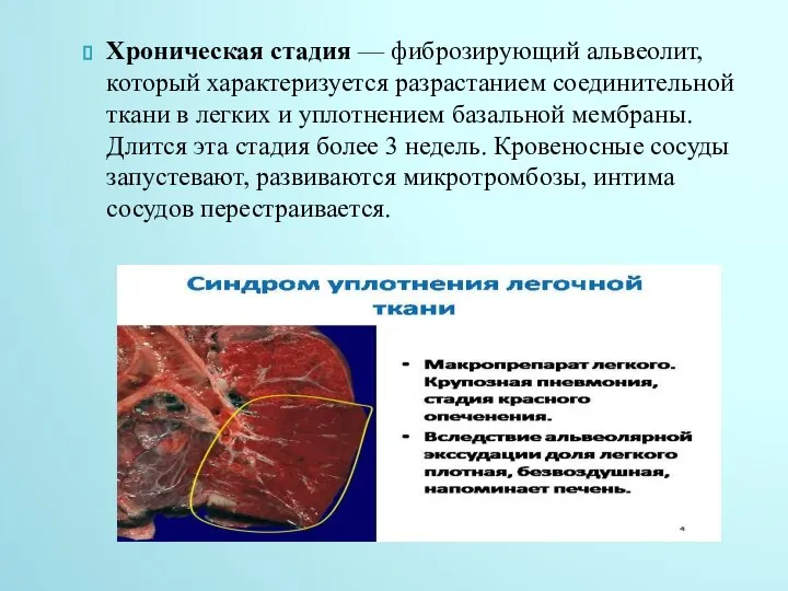 Хроническая стадия — фиброзирующий альвеолит, который характеризуется разрастанием соединительной ткани в