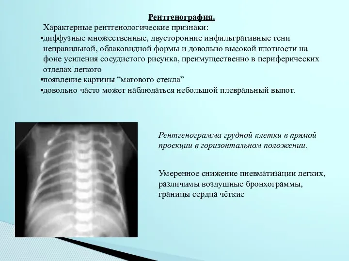 Рентгенография. Характерные рентгенологические признаки: диффузные множественные, двусторонние инфильтративные тени неправильной, облаковидной