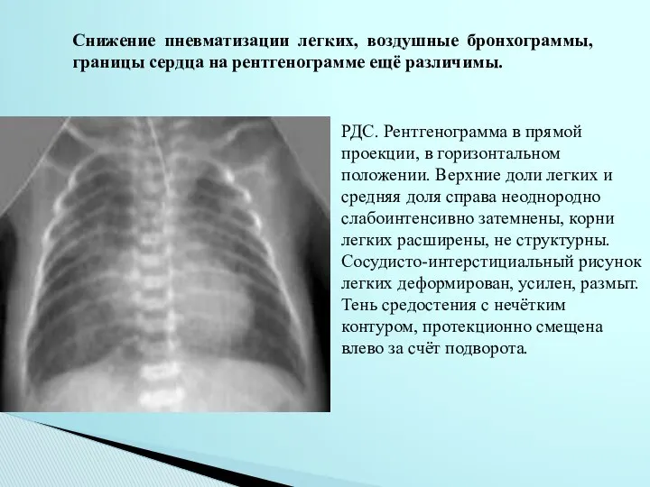 Снижение пневматизации легких, воздушные бронхограммы, границы сердца на рентгенограмме ещё различимы.