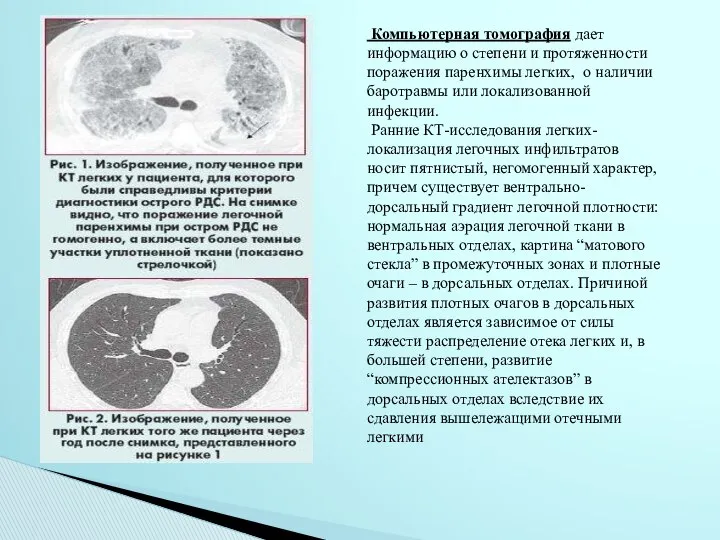 Компьютерная томография дает информацию о степени и протяженности поражения паренхимы легких,