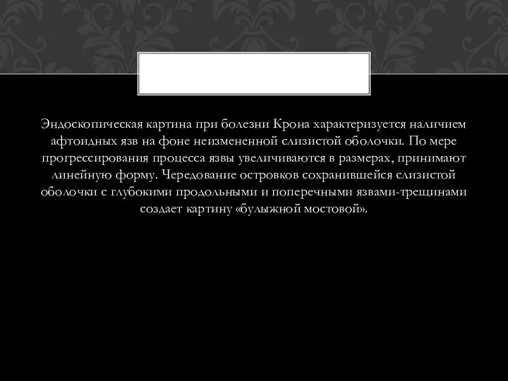 Эндоскопическая картина при болезни Крона характеризуется наличием афтоидных язв на фоне