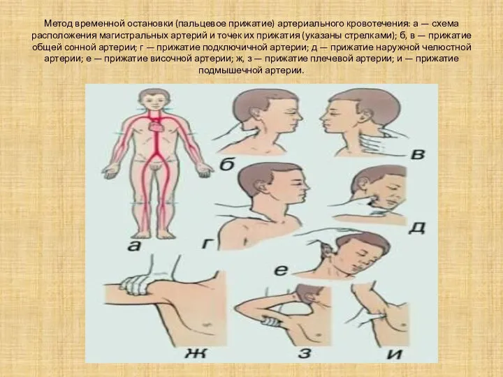 Метод временной остановки (пальцевое прижатие) артериального кровотечения: а — схема расположения
