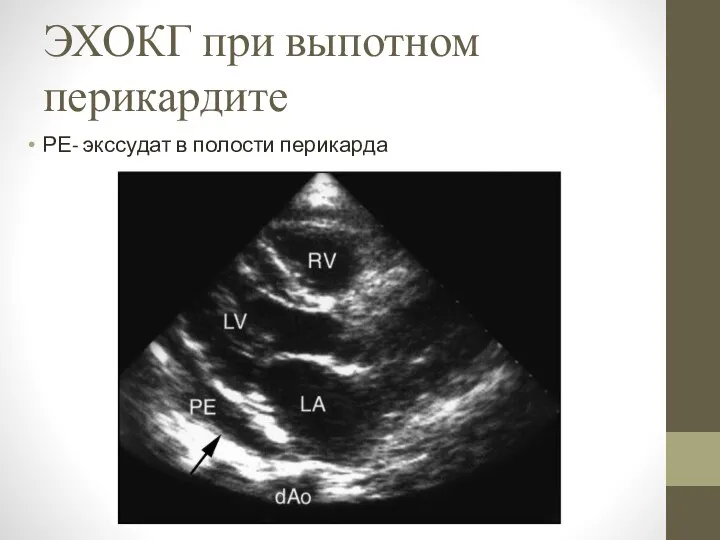 ЭХОКГ при выпотном перикардите РЕ- экссудат в полости перикарда