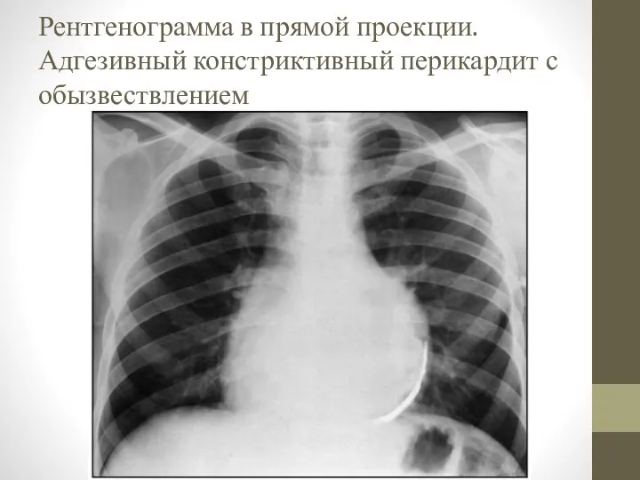 Рентгенограмма в прямой проекции. Адгезивный констриктивный перикардит с обызвествлением