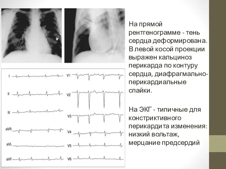 На прямой рентгенограмме - тень сердца деформирована. В левой косой проекции