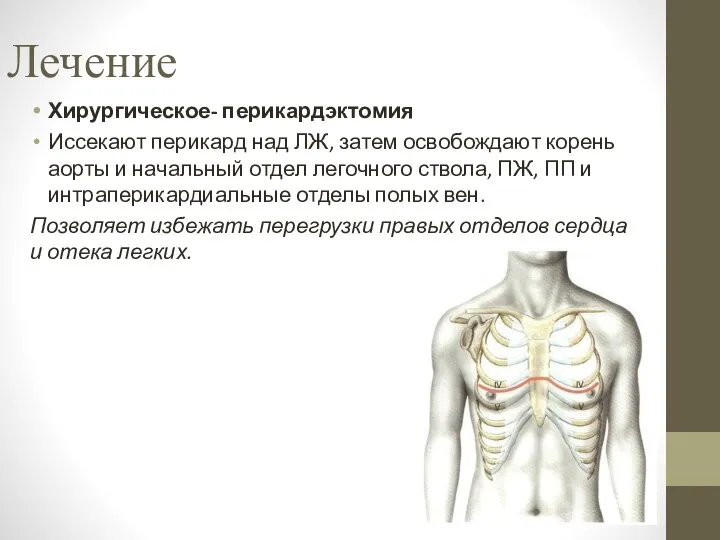 Лечение Хирургическое- перикардэктомия Иссекают перикард над ЛЖ, затем освобождают корень аорты