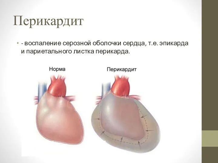 Перикардит - воспаление серозной оболочки сердца, т.е. эпикарда и париетального листка перикарда.