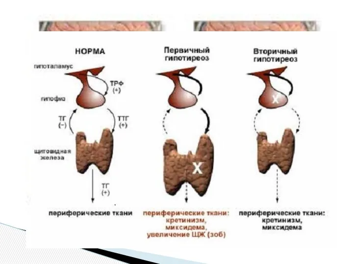 Первичный гипотиреоз возникает в результате патологий щитовидной железы. Вторичную форму заболевания