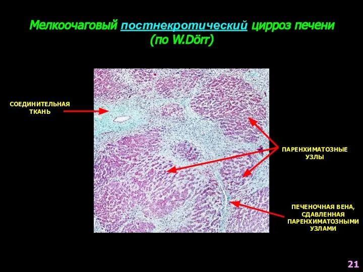 Мелкоочаговый постнекротический цирроз печени (по W.Dörr) ПАРЕНХИМАТОЗНЫЕ УЗЛЫ ПЕЧЕНОЧНАЯ ВЕНА, СДАВЛЕННАЯ ПАРЕНХИМАТОЗНЫМИ УЗЛАМИ СОЕДИНИТЕЛЬНАЯ ТКАНЬ 21