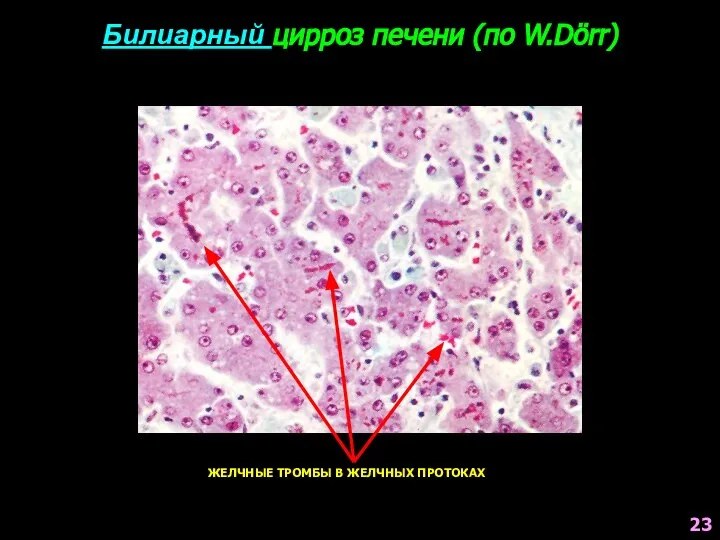 Билиарный цирроз печени (по W.Dörr) ЖЕЛЧНЫЕ ТРОМБЫ В ЖЕЛЧНЫХ ПРОТОКАХ 23