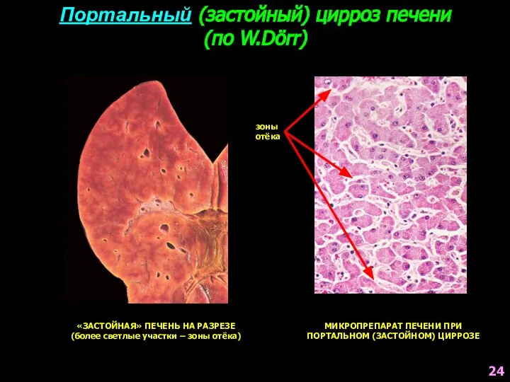 Портальный (застойный) цирроз печени (по W.Dörr) «ЗАСТОЙНАЯ» ПЕЧЕНЬ НА РАЗРЕЗЕ (более