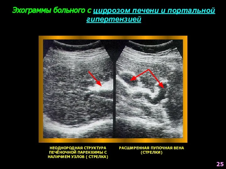 Эхограммы больного с циррозом печени и портальной гипертензией НЕОДНОРОДНАЯ СТРУКТУРА ПЕЧЁНОЧНОЙ