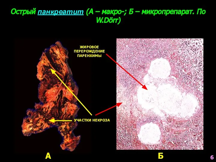 Острый панкреатит (А – макро-; Б – микропрепарат. По W.Dörr) А