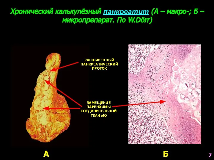 Хронический калькулёзный панкреатит (А – макро-; Б – микропрепарат. По W.Dörr)