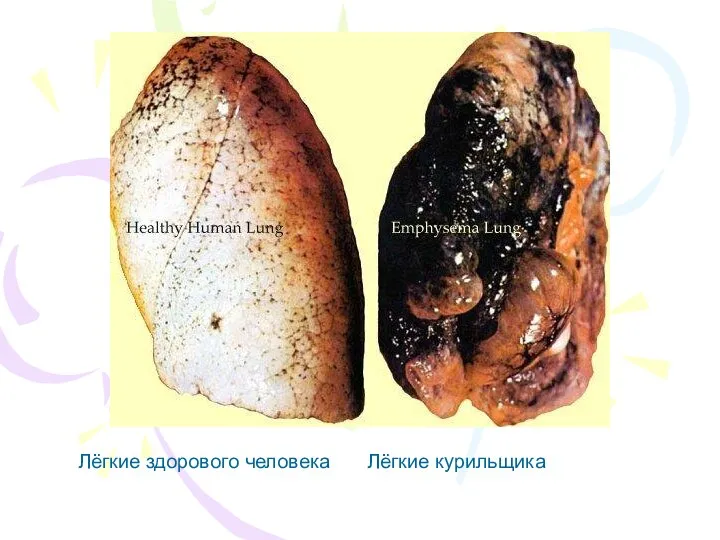 Лёгкие здорового человека Лёгкие курильщика