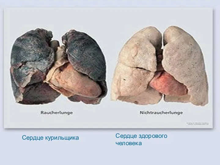 Сердце курильщика Сердце здорового человека