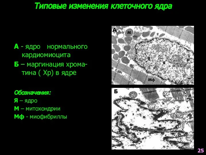 Типовые изменения клеточного ядра А - ядро нормального кардиомиоцита Б –