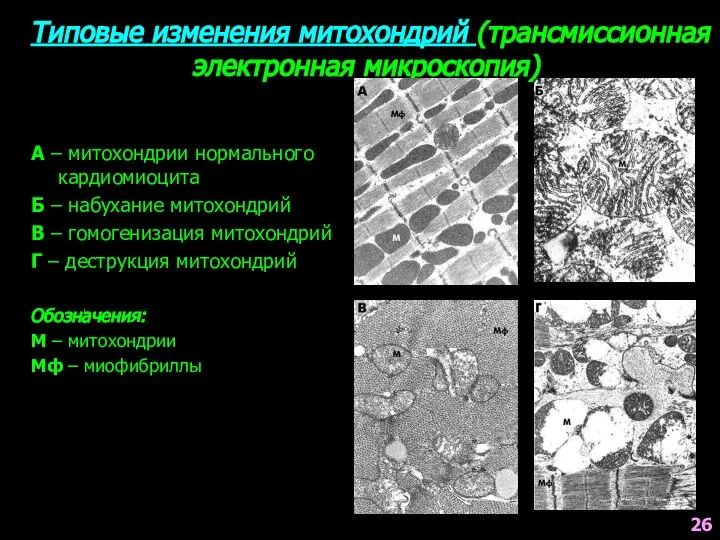 Типовые изменения митохондрий (трансмиссионная электронная микроскопия) А – митохондрии нормального кардиомиоцита