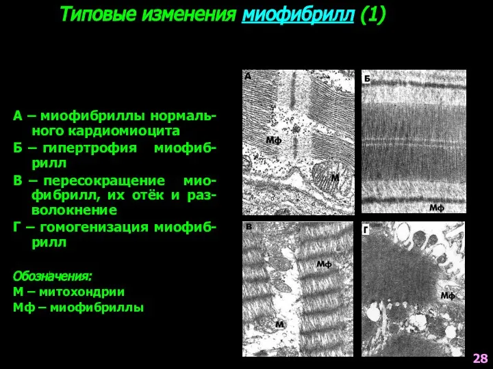 Типовые изменения миофибрилл (1) А – миофибриллы нормаль-ного кардиомиоцита Б –