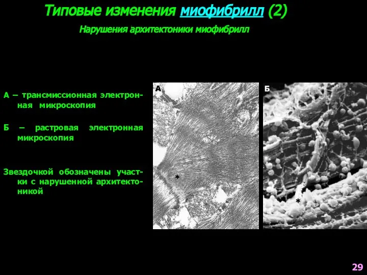 Типовые изменения миофибрилл (2) Нарушения архитектоники миофибрилл А – трансмиссионная электрон-ная