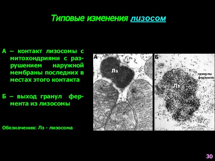 Типовые изменения лизосом А – контакт лизосомы с митохондриями с раз-рушением