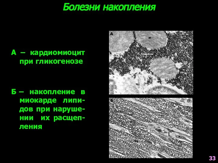 Болезни накопления А – кардиомиоцит при гликогенозе Б – накопление в