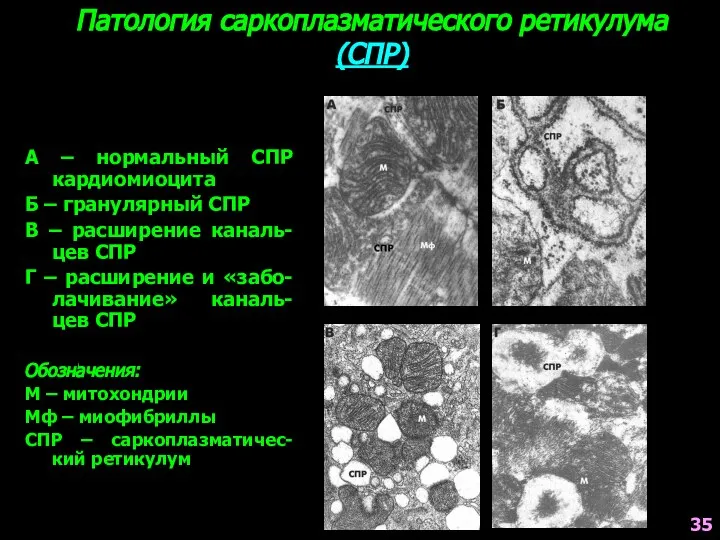 Патология саркоплазматического ретикулума (СПР) А – нормальный СПР кардиомиоцита Б –