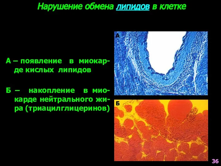 Нарушение обмена липидов в клетке А – появление в миокар-де кислых