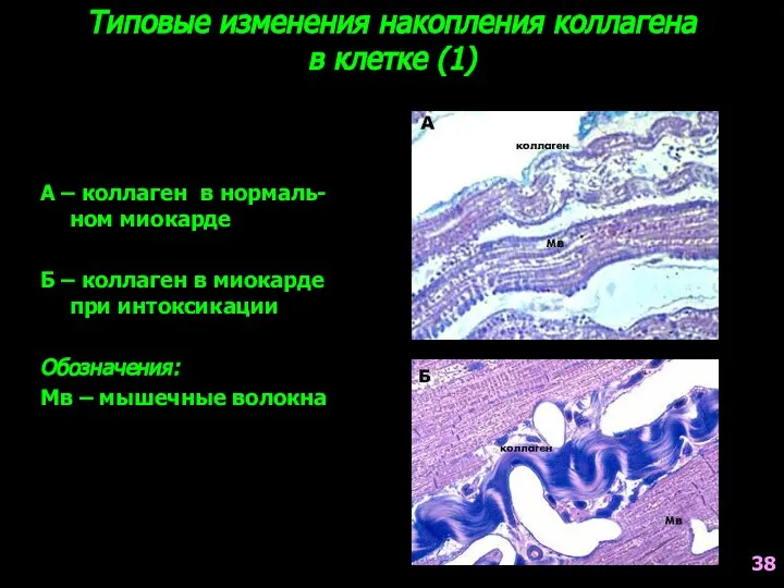 Типовые изменения накопления коллагена в клетке (1) А – коллаген в