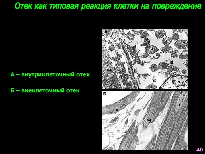 Отек как типовая реакция клетки на повреждение А – внутриклеточный отек Б – внеклеточный отек 40