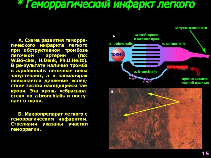 * Геморрагический инфаркт легкого А a. pulmonalis v. pulmonalis a. bronchialis